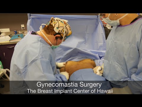 Honolulu Gynecomastia Surgery (Graphic) - Part Two - Liposuction to Remove Pseudo Gynecomastia - Breast Implant Center of Hawaii