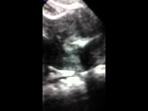 Ultrasound Guided Embryo Transfer at CNY Fertility