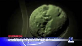 El departamento de salud de Minnesota anuncia un aumento  en los casos de tuberculosis durante el año 2016