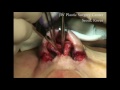 JW PLASTIC SURGERY CENTER - Rhinoplasty (Korea Plastic Surgery) Part 1