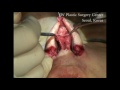 JW PLASTIC SURGERY CENTER - Rhinoplasty (Korea Plastic Surgery) Part 1