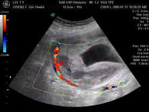 placenta previa research paper placenta previa research paper