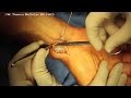 Live Surgery: Ganglion Cyst Volar Wrist