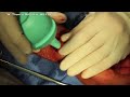 Live Surgery: Ganglion Cyst Volar Wrist