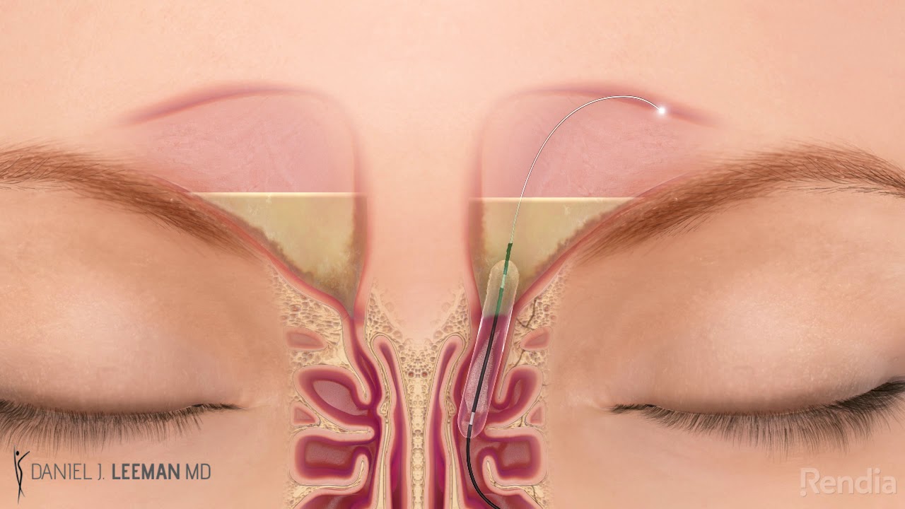 Balloon Sinuplasty Austin