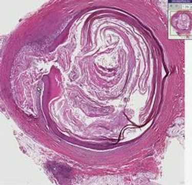 Histopathology Skin--Epidermal inclusion cyst