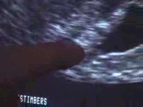 ultrasounds at 6 weeks. Ultrasound at 6 weeks #4