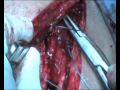 Shoulder Resurfacing Procedure JRGC Chennai Part-2