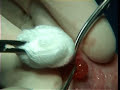 Surgical removal of mucocele from lower lip