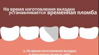 Протезирование зубов вкладками