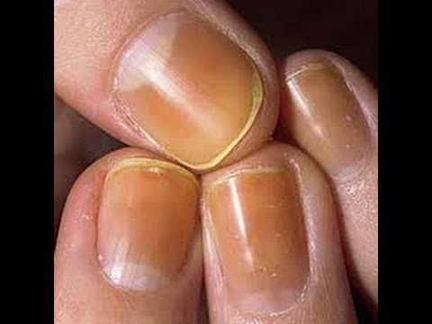 Applicazione di un chistotel da un fungo di unghie