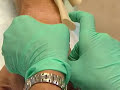 Intravenous line insertion