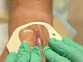 Intravenous line insertion