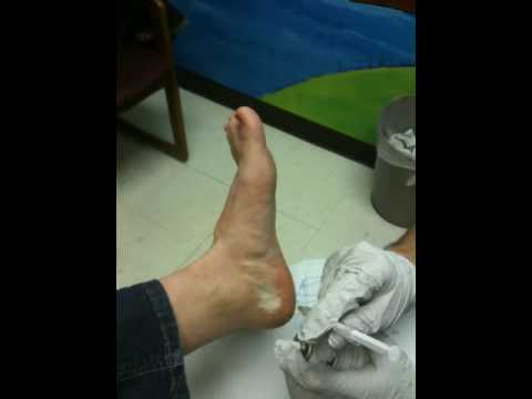 Are steroid injections for plantar fasciitis painful