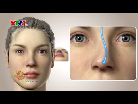 Chất liệu mới trong nâng mũi