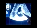 7 weeks & 2 days Ultrasound & we hear the heartbeat!