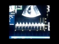 7 weeks & 2 days Ultrasound & we hear the heartbeat!
