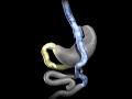 Gastric Bypass animation