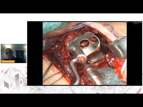 Video 2: Operative Technique thumbnail