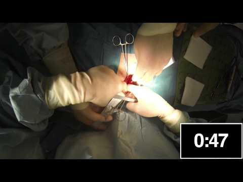 Inserimento di protesi autoancorante in tempo reale