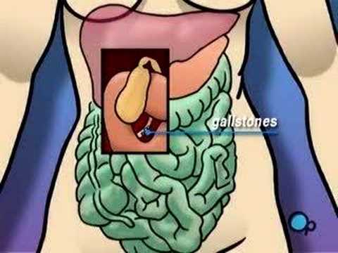 gallbladder removal laparoscopic. Gallbladder Removal