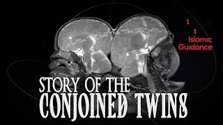 The Story Of The Conjoined Twins