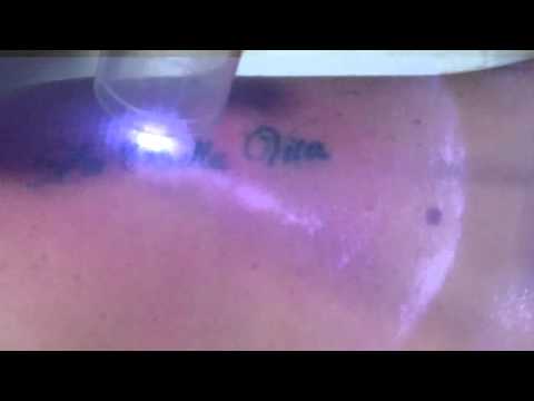  ago Dr Humes performing Laser Tattoo Removal Treatment at VITAHL