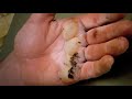 Hand Burnt in Tar - Part 2 - Bizarre ER