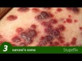 TOP 10 WORST DISEASES