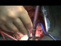 Heart Bypass Surgery Explained Part2