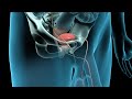 3D Animation of Radical Prostate Cancer Surgery