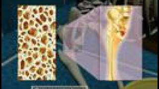 Osteoporosis-3D Medical Animation - YouTube
