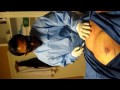 Video: Male Breast Liposuction-SmartLipo-Gynaecomastia Liposuction-Valley Aesthetics