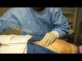 Video: SmartLipo-Outer Thigh-Liposuction-Outer Thigh-Cynosure SmartLipo MPX