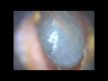 Ear wax removal Unbelievable what comes out,