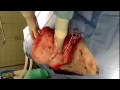 Veterinary Surgeon Removes Massive Lipoma (Fatty Tumor) from a Dog