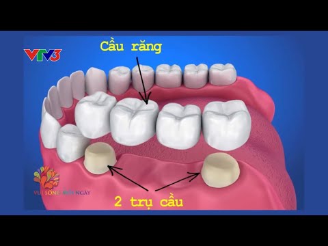 Kỹ thuật cấy ghép implant hiện đại - Robot định vị cấy ghép implant