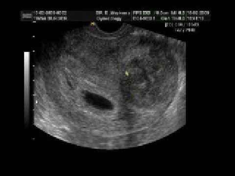 ultrasounds at 6 weeks. Ultrasound: 6 Weeks and 4 days
