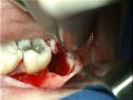 Removal Of An Impacted Wisdom Tooth-Mesioangular impaction (3)