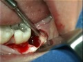 Removal Of An Impacted Wisdom Tooth-Mesioangular impaction (3)