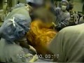 World's Largest Tumor