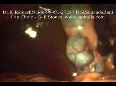 gallbladder stones removal. Gall Stones - Lap Chole