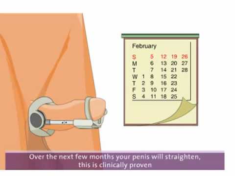 Device to straighten bent or curved penis naturally brycoon 32660 views 2