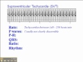 ECG: Supraventricular Tachycardia (SVT)