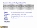 ECG: Supraventricular Tachycardia (SVT)