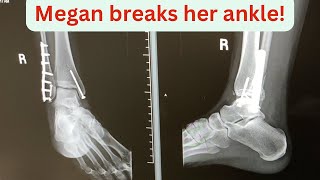 Megan Breaks Her Ankle; A Recovery Adventure. A Walking Miracle! #wellness #trending #art #love
