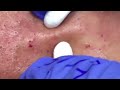Download Video Blackheads Extractions “K’s” 3rd Treatment 02 Download Video Blackheads Extractions “K’s” 3rd Treatment 02