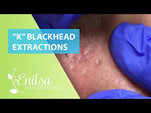Download Video Blackheads Extractions “K’s” 3rd Treatment Download Video Blackheads Extractions “K’s” 3rd Treatment