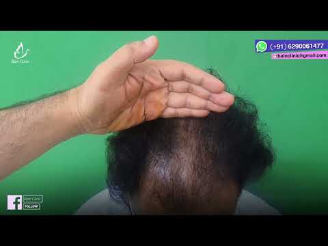 FUT হেয়ার ট্রান্সপ্লান্ট নিয়ে আলোচনা | কলকাতা |  Dr. Jayanta Bain plastic surgeon