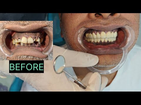 Full Mouth Smile Makeover Before and After | Complete Dental Transformation